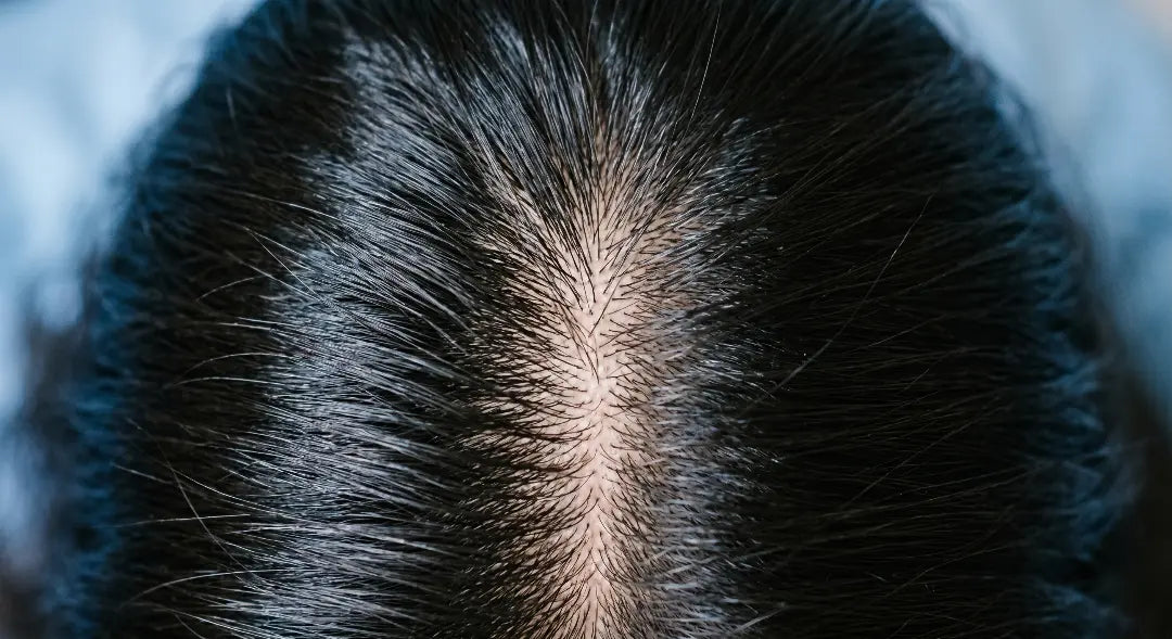 Telogen Effluvium & GLP-1 Hair Loss: Causes and Treatment Guide